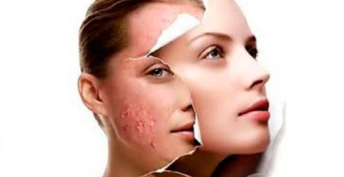acnes-e-espinhas-tratamento