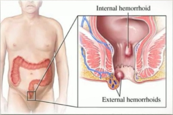 diferença entre hemorroida interna e externa